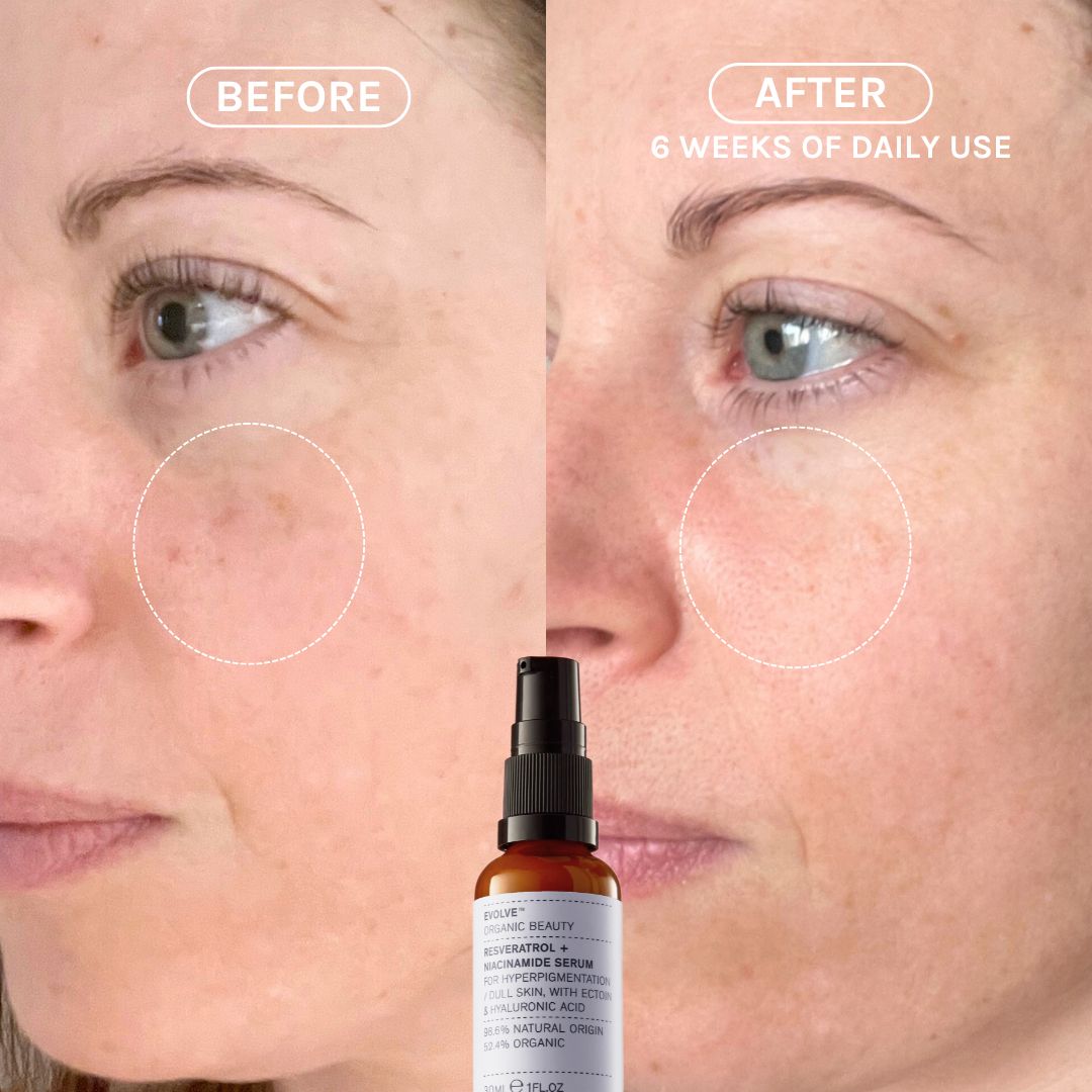 before and after, sigificantly reduces age spots and hyperpigmentation 